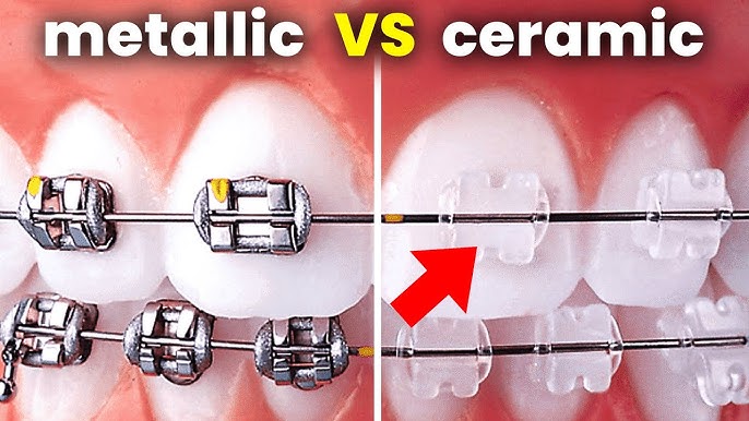Metal vs Ceramic braces