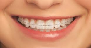Ceramic Braces