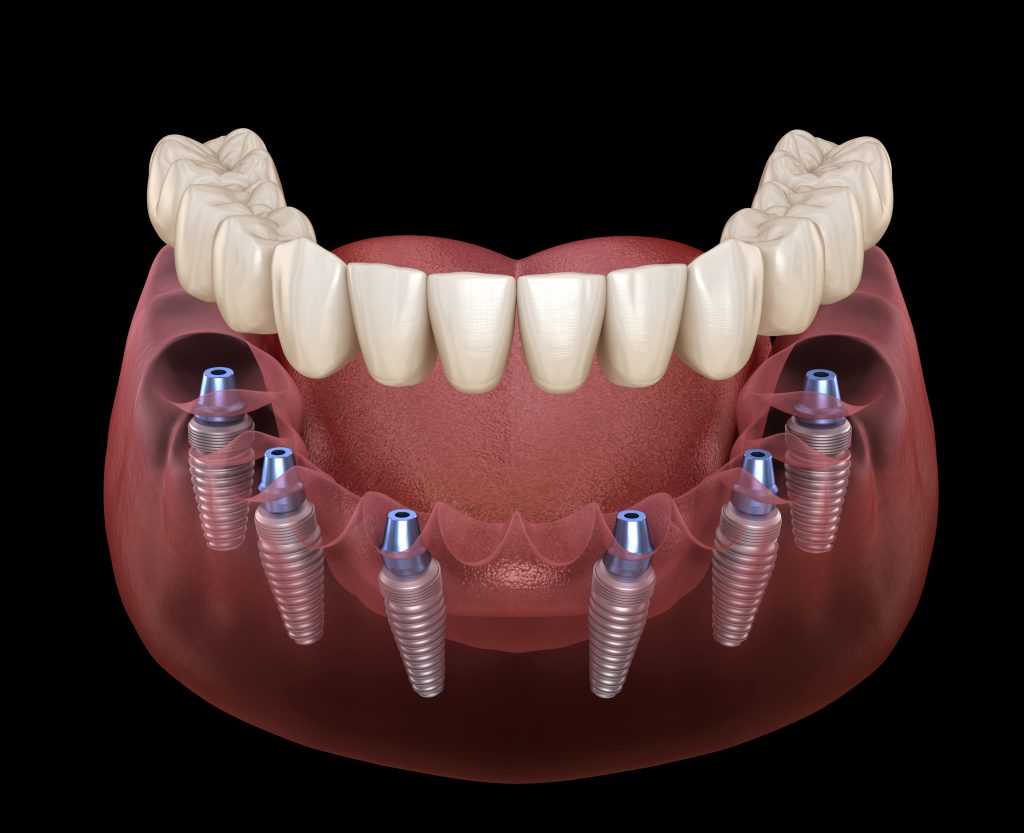  All-on-4 vs All-on-6 Implants 