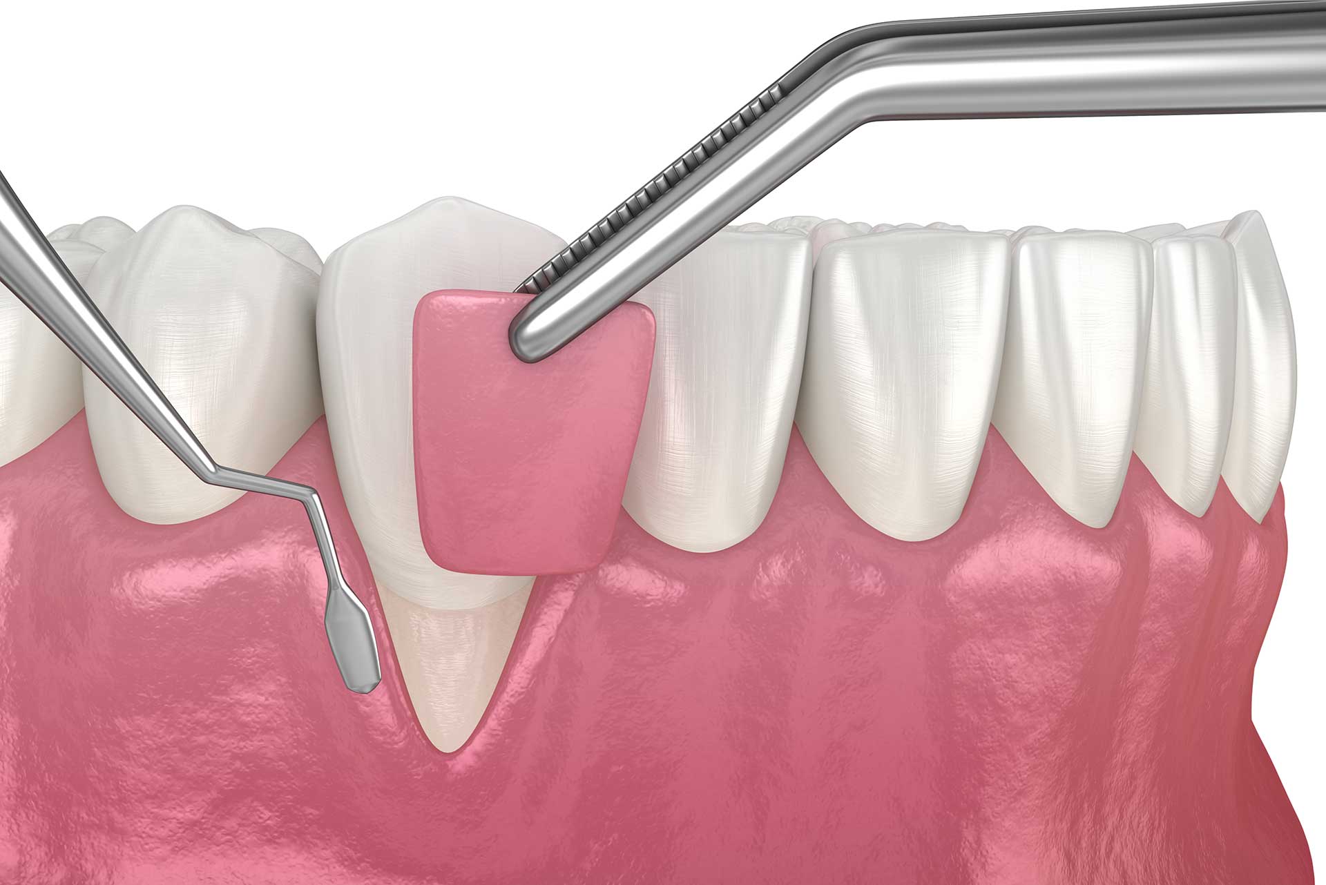 Gum Correction