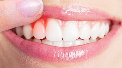 Gum Disease Treatment