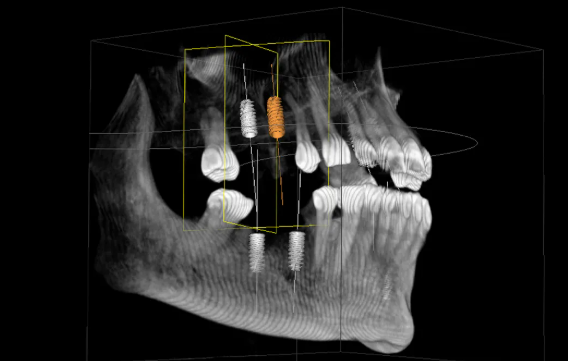 single visit implants