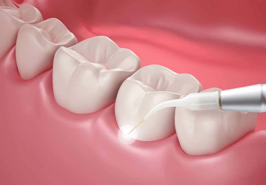 MicroScopic RootCanal
