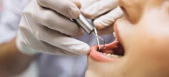 Laser RootCanal