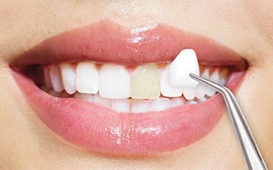 Veneers and Laminates