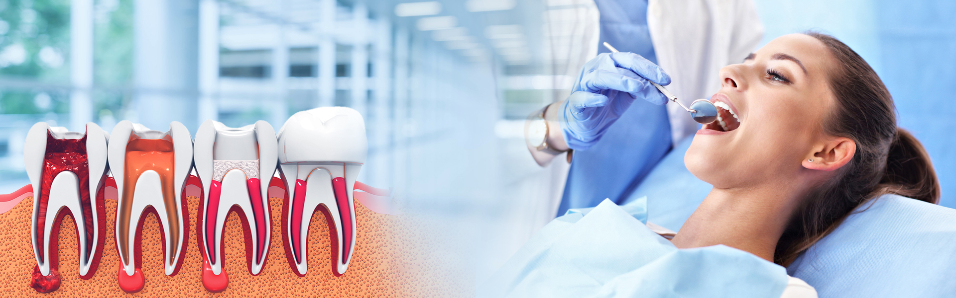 RootCanal Treatment In Kukatpally