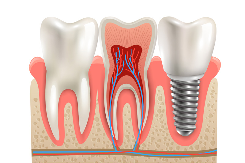 Same Day Dental Implants