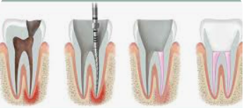 root canal