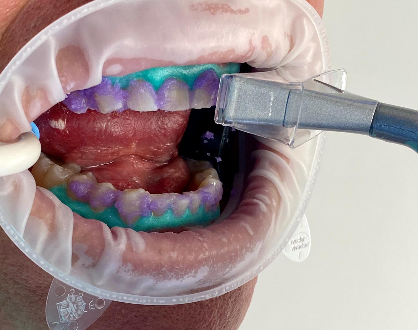 Laser Whitening